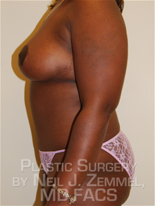 Tummy Tuck After Photo by Neil Zemmel, MD, FACS; Richmond, VA - Case 29546