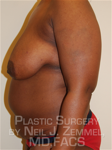 Tummy Tuck Before Photo by Neil Zemmel, MD, FACS; Richmond, VA - Case 29546