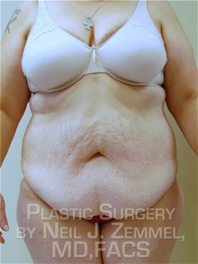 Tummy Tuck Before Photo by Neil Zemmel, MD, FACS; Richmond, VA - Case 29548