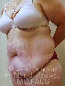 Tummy Tuck Before Photo by Neil Zemmel, MD, FACS; Richmond, VA - Case 29548