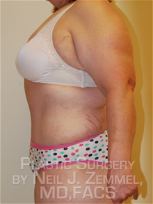 Tummy Tuck After Photo by Neil Zemmel, MD, FACS; Richmond, VA - Case 29548