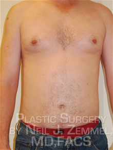 Liposuction After Photo by Neil Zemmel, MD, FACS; Richmond, VA - Case 29554