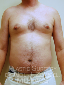 Liposuction Before Photo by Neil Zemmel, MD, FACS; Richmond, VA - Case 29554