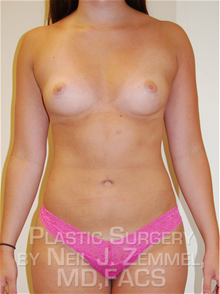 LSNA Suction Liposuction After Photo by Neil Zemmel, MD, FACS; Richmond, VA - Case 29555