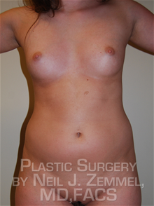 LSNA Suction Liposuction Before Photo by Neil Zemmel, MD, FACS; Richmond, VA - Case 29555