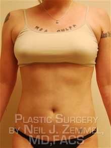 LSNA Suction Liposuction After Photo by Neil Zemmel, MD, FACS; Richmond, VA - Case 29556