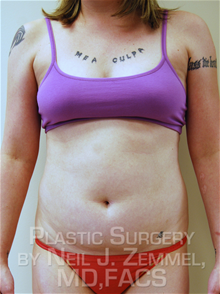 LSNA Suction Liposuction Before Photo by Neil Zemmel, MD, FACS; Richmond, VA - Case 29556