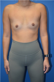 Breast Augmentation Before Photo by Neil Zemmel, MD, FACS; Richmond, VA - Case 47441