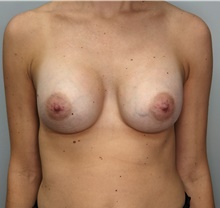 Breast Augmentation After Photo by F. Ryan Wermeling, MD; Louisville, KY - Case 47332
