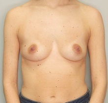 Breast Augmentation Before Photo by F. Ryan Wermeling, MD; Louisville, KY - Case 47332