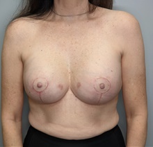 Breast Implant Revision After Photo by F. Ryan Wermeling, MD; Louisville, KY - Case 47339