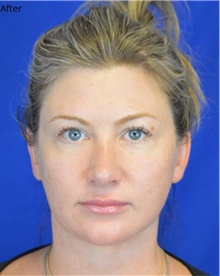 Facelift After Photo by Timothy Rankin, MD; Greenbrae, CA - Case 48910