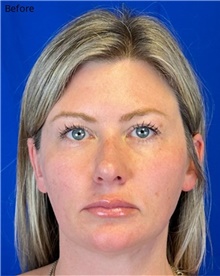 Facelift Before Photo by Timothy Rankin, MD; Greenbrae, CA - Case 48910