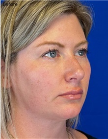 Facelift Before Photo by Timothy Rankin, MD; Greenbrae, CA - Case 48910