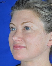 Facelift After Photo by Timothy Rankin, MD; Greenbrae, CA - Case 48910