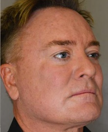 Facelift After Photo by Timothy Rankin, MD; Greenbrae, CA - Case 48911