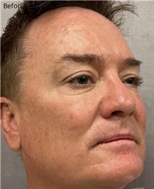 Facelift Before Photo by Timothy Rankin, MD; Greenbrae, CA - Case 48911