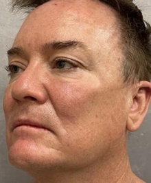 Facelift Before Photo by Timothy Rankin, MD; Greenbrae, CA - Case 48911