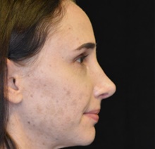 Rhinoplasty After Photo by Timothy Rankin, MD; Greenbrae, CA - Case 48912