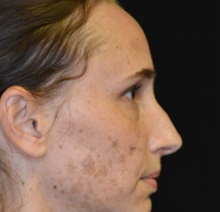 Rhinoplasty Before Photo by Timothy Rankin, MD; Greenbrae, CA - Case 48912