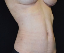 Liposuction After Photo by Timothy Rankin, MD; Greenbrae, CA - Case 48915