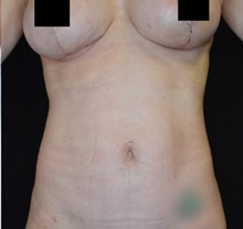 Liposuction After Photo by Timothy Rankin, MD; Greenbrae, CA - Case 48915