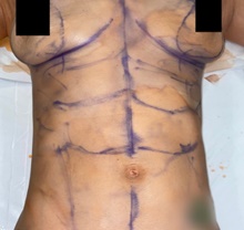 Liposuction Before Photo by Timothy Rankin, MD; Greenbrae, CA - Case 48915