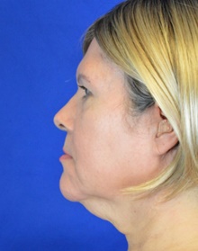 Facelift Before Photo by Timothy Rankin, MD; Greenbrae, CA - Case 48916