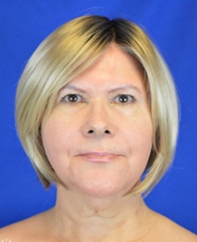 Facelift Before Photo by Timothy Rankin, MD; Greenbrae, CA - Case 48916