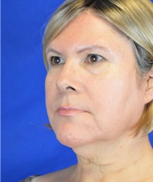 Facelift Before Photo by Timothy Rankin, MD; Greenbrae, CA - Case 48916