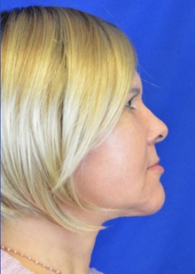 Facelift After Photo by Timothy Rankin, MD; Greenbrae, CA - Case 48916