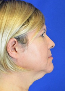 Facelift Before Photo by Timothy Rankin, MD; Greenbrae, CA - Case 48916