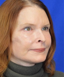 Facelift After Photo by Timothy Rankin, MD; Greenbrae, CA - Case 48917