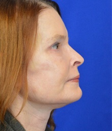 Facelift After Photo by Timothy Rankin, MD; Greenbrae, CA - Case 48917