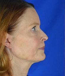 Facelift Before Photo by Timothy Rankin, MD; Greenbrae, CA - Case 48917