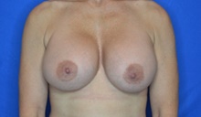 Breast Augmentation After Photo by Timothy Rankin, MD; Greenbrae, CA - Case 49123