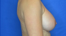 Breast Augmentation After Photo by Timothy Rankin, MD; Greenbrae, CA - Case 49123