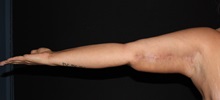 Arm Lift After Photo by David Boudreault, MD; Palo Alto, CA - Case 35521