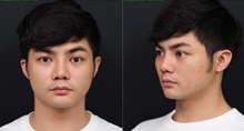 Rhinoplasty After Photo by Chi Chen Huang, MD; Taichung City,  - Case 29980