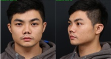 Rhinoplasty Before Photo by Chi Chen Huang, MD; Taichung City,  - Case 29980