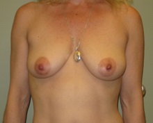 Breast Augmentation Before Photo by Badar Jan, MD; Allentown, PA - Case 30980