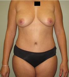 Tummy Tuck After Photo by Badar Jan, MD; Allentown, PA - Case 30981