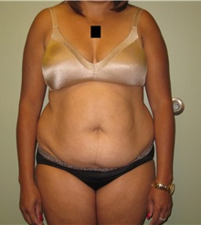 Tummy Tuck Before Photo by Badar Jan, MD; Allentown, PA - Case 30981