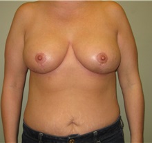 Breast Reduction After Photo by Badar Jan, MD; Allentown, PA - Case 30993