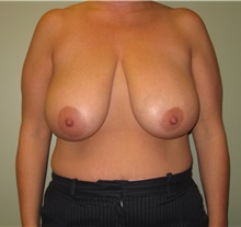 Breast Reduction Before Photo by Badar Jan, MD; Allentown, PA - Case 30993