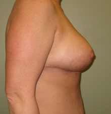 Breast Reduction After Photo by Badar Jan, MD; Allentown, PA - Case 30993
