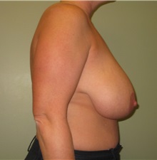 Breast Reduction Before Photo by Badar Jan, MD; Allentown, PA - Case 30993