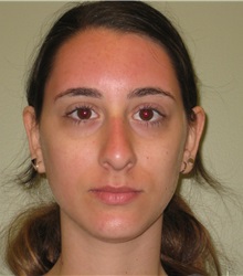 Rhinoplasty Before Photo by Badar Jan, MD; Allentown, PA - Case 30994