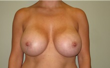 Breast Augmentation After Photo by Badar Jan, MD; Allentown, PA - Case 30995