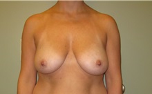 Breast Augmentation Before Photo by Badar Jan, MD; Allentown, PA - Case 30995